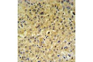 Immunohistochemistry analysis in formalin fixed and paraffin embedded hepatocarcinoma reacted with INSC Antibody (Center) followed by peroxidase conjugation of the secondary antibody and DAB staining. (INSC antibody  (Middle Region))