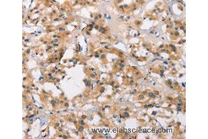 Immunohistochemistry of Human thyroid cancer using MARC1 Polyclonal Antibody at dilution of 1:40