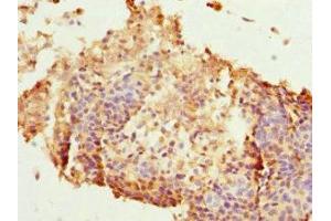 Immunohistochemistry of paraffin-embedded human cervical cancer using ABIN7165626 at dilution of 1:100 (HEXIM1 antibody  (AA 210-359))