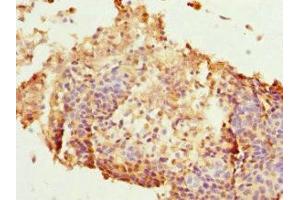 Immunohistochemistry of paraffin-embedded human cervical cancer using ABIN7165626 at dilution of 1:100