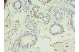 Immunohistochemistry of paraffin-embedded human breast cancer using ABIN7158756 at dilution of 1:100 (LYPLAL1 antibody  (AA 2-237))