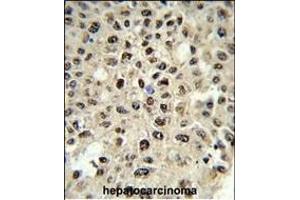 Formalin-fixed and paraffin-embedded human hepatocarcinoma reacted with SSB Antibody (N-term) (ABIN1882133 and ABIN2839422) , which was peroxidase-conjugated to the secondary antibody, followed by DAB staining. (SSB antibody  (N-Term))