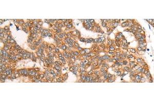 Immunohistochemistry of paraffin-embedded Human liver cancer tissue using CDON Polyclonal Antibody at dilution of 1:65(x200) (CDON antibody)