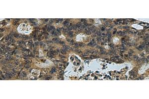 Immunohistochemistry of paraffin-embedded Human colorectal cancer tissue using PLTP Polyclonal Antibody at dilution of 1:60(x200)