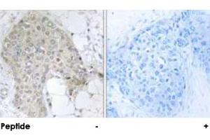 Immunohistochemical analysis of paraffin-embedded human breast carcinoma tissue using PPP1R2 polyclonal antibody . (PPP1R2 antibody  (Ser120, Ser121))