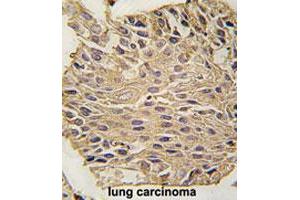 Formalin-fixed and paraffin-embedded human lung carcinomareacted with ALDOA polyclonal antibody , which was peroxidase-conjugated to the secondary antibody, followed by AEC staining. (ALDOA antibody  (C-Term))