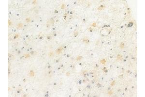 ABIN6264878 and ABIN6272422 at 1/100 staining human astrocytoma by IHC-P. (RTCD1 antibody  (C-Term))