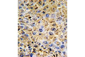 Formalin-fixed and paraffin-embedded human hepatocarcinoma with DCN Antibody , which was peroxidase-conjugated to the secondary antibody, followed by DAB staining.