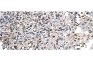 Immunohistochemistry of paraffin-embedded Human breast cancer tissue using KDM5C Polyclonal Antibody at dilution 1:45 (KDM5C antibody)