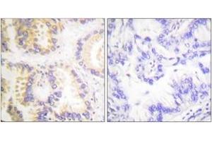 Immunohistochemistry analysis of paraffin-embedded human lung carcinoma, using Caspase 8 (Phospho-Ser347) Antibody.