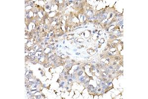 Immunohistochemistry of paraffin-embedded human breast cancer using HINT1 Rabbit mAb (ABIN7267663) at dilution of 1:50 (40x lens). (HINT1 antibody)