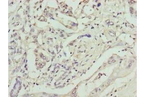 Immunohistochemistry of paraffin-embedded human pancreatic cancer using ABIN7161374 at dilution of 1:100 (GPM6B antibody  (AA 1-64))