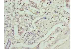 Immunohistochemistry of paraffin-embedded human pancreatic cancer using ABIN7161374 at dilution of 1:100 (GPM6B antibody  (AA 1-64))