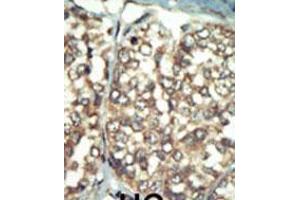 Formalin-fixed and paraffin-embedded human cancer tissue reacted with the primary antibody, which was peroxidase-conjugated to the secondary antibody, followed by AEC staining. (PI4K2B antibody  (C-Term))