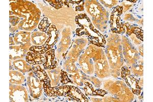 ABIN6258796 and ABIN6275126 at 1/100 staining Human kidney cancer and adjacent normal tissues by IHC-P. (FOLR1 antibody  (Internal Region))