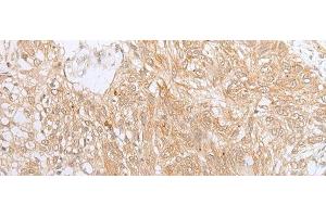 Immunohistochemistry of paraffin-embedded Human lung cancer tissue using ZNF34 Polyclonal Antibody at dilution of 1:40(x200) (ZNF34 antibody)