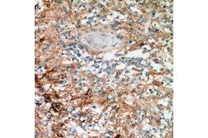 Immunohistochemical analysis of Nanos 1 staining in human breast cancer formalin fixed paraffin embedded tissue section. (Nanos Homolog 1 antibody)