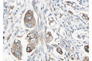 ABIN6267549 at 1/100 staining human Stomach cancer tissue sections by IHC-P.