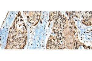 Immunohistochemistry of paraffin-embedded Human esophagus cancer tissue using CASK Polyclonal Antibody at dilution of 1:65(x200) (CASK antibody)