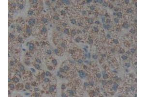 IHC-P analysis of Human Liver Cancer Tissue, with DAB staining. (Cytokeratin 1 antibody  (AA 487-644))