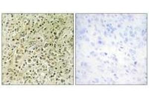 Immunohistochemistry analysis of paraffin-embedded human prostate carcinoma tissue, using RHG07 antibody. (DLC1 antibody)