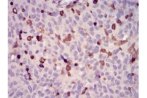 Immunohistochemical analysis of paraffin-embedded ovarian cancer tissues using WAS mouse mAb with DAB staining. (WASP antibody  (AA 57-170))