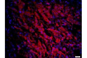 Paraformaldehyde-fixed, paraffin embedded human liver cancer, Antigen retrieval by boiling in sodium citrate buffer (pH6) for 15min, Block endogenous peroxidase by 3% hydrogen peroxide for 20 minutes, Blocking buffer (normal goat serum) at 37°C for 30min, Antibody incubation with CCR6 Polyclonal Antibody, Unconjugated  at 1:200 overnight at 4°C, followed by a conjugated secondary -AF594) at [1:500] for 90 minutes and DAPI staining of the nuclei. (CCR6 antibody  (AA 201-300))