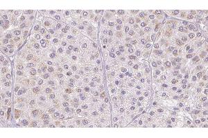 ABIN6277547 at 1/100 staining Human melanoma tissue by IHC-P. (AZGP1 antibody  (Internal Region))