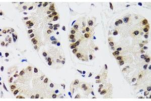 Immunohistochemistry of paraffin-embedded Human gastric cancer using EDF1 Polyclonal Antibody at dilution of 1:100 (40x lens).