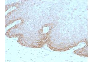 Formalin-fixed, paraffin-embedded human Cervical Carcinoma stained with Protocadherin FAT2 Monoclonal Antibody (8C5). (FAT Atypical Cadherin 2 (FAT2) antibody)