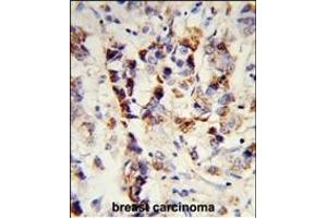 Formalin-fixed and paraffin-embedded human breast carcinoma reacted with SKIV2L2 Antibody (Center), which was peroxidase-conjugated to the secondary antibody, followed by DAB staining.