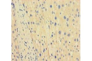 Immunohistochemistry of paraffin-embedded human liver cancer using ABIN7171563 at dilution of 1:100 (TBPL1 antibody  (AA 1-185))