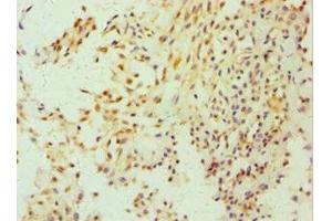 Immunohistochemistry of paraffin-embedded human breast cancer using ABIN7152857 at dilution of 1:100