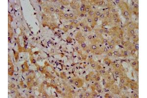 IHC image of ABIN7145800 diluted at 1:800 and staining in paraffin-embedded human liver cancer performed on a Leica BondTM system.