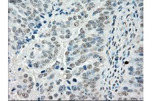 Immunohistochemical staining of paraffin-embedded Adenocarcinoma of colon tissue using anti-PORmouse monoclonal antibody. (POR antibody)