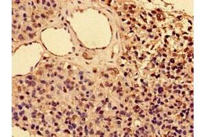 Immunohistochemistry of paraffin-embedded human glioma using ABIN7156842 at dilution of 1:100 (CD25 antibody  (AA 22-185))