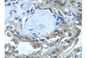 Detection of TGFa in Human Thyroid cancer Tissue using Monoclonal Antibody to Transforming Growth Factor Alpha (TGFa) (TGFA antibody  (AA 24-98))