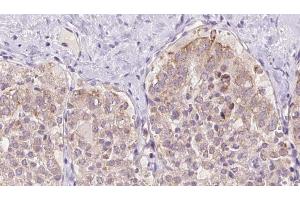 ABIN6273341 at 1/100 staining Human thyroid cancer tissue by IHC-P. (USP33 antibody  (Internal Region))