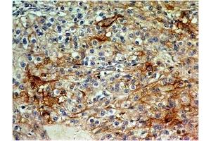 Immunohistochemical analysis of CD73  in renal cell carcinoma using CD73 antibody (Clone: ABM40E2) at 5 µg/ml. (CD73 antibody  (AA 145-346))