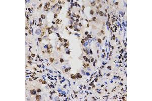 Immunohistochemistry of paraffin-embedded human lung cancer tissue using H3R17me2a antibody at dilution of 1:200 (x400 lens) (Histone 3 antibody  (H3R17me2a))