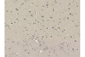 ABIN6264172 and ABIN6273294 at 1/100 staining human glioblastoma by IHC-P.