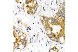 Immunohistochemistry of paraffin-embedded human liver cancer using TOMM20 antibody at dilution of 1:100 (x40 lens).