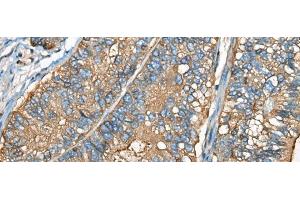 Immunohistochemistry of paraffin-embedded Human gastric cancer tissue using CEACAM8 Polyclonal Antibody at dilution of 1:30(x200) (CEACAM8 antibody)