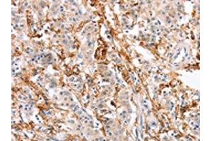 The image on the left is immunohistochemistry of paraffin-embedded Human gastric cancer tissue using ABIN7131059(SIGLEC9 Antibody) at dilution 1/30, on the right is treated with fusion protein. (SIGLEC9 antibody)