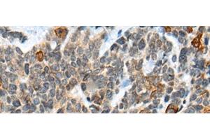 Immunohistochemistry of paraffin-embedded Human thyroid cancer tissue using ATRX Polyclonal Antibody at dilution of 1:50(x200) (ATRX antibody)