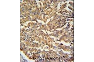 KRT19 Antibody (C-term) (ABIN389327 and ABIN2839443) IHC analysis in formalin fixed and paraffin embedded human Lung carcinoma followed by peroxidase conjugation of the secondary antibody and DAB staining. (Cytokeratin 19 antibody  (C-Term))