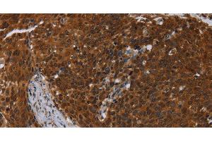Immunohistochemistry of paraffin-embedded Human cervical cancer using MCHR1 Polyclonal Antibody at dilution of 1:30