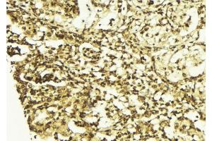 ABIN6267513 at 1/100 staining Human breast cancer tissue by IHC-P. (STAT5 A/B antibody  (pSer725, pSer730))