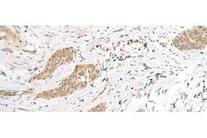 Immunohistochemistry of paraffin-embedded Human esophagus cancer tissue using ENSA Polyclonal Antibody at dilution of 1:40(x200)