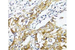 Immunohistochemistry of paraffin-embedded Human liver cancer using GLUT4 Polyclonal Antibody at dilution of 1:100 (40x lens). (GLUT4 antibody)